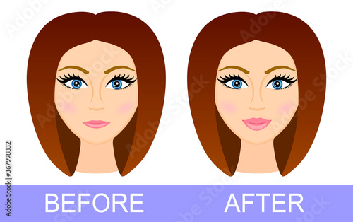 Before after lip correction. Woman after using lip filler. Lip Augmentation. Before and after lip filler injections. Hyaluronic Acid injections. Vector illustration. Poster. Banner. Plastic surgery