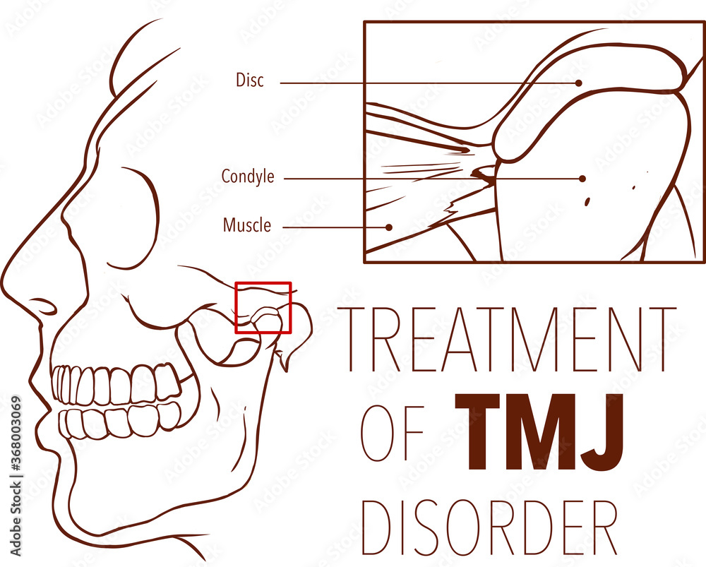 Obraz premium Vector illustration of treatment of tmj disorder