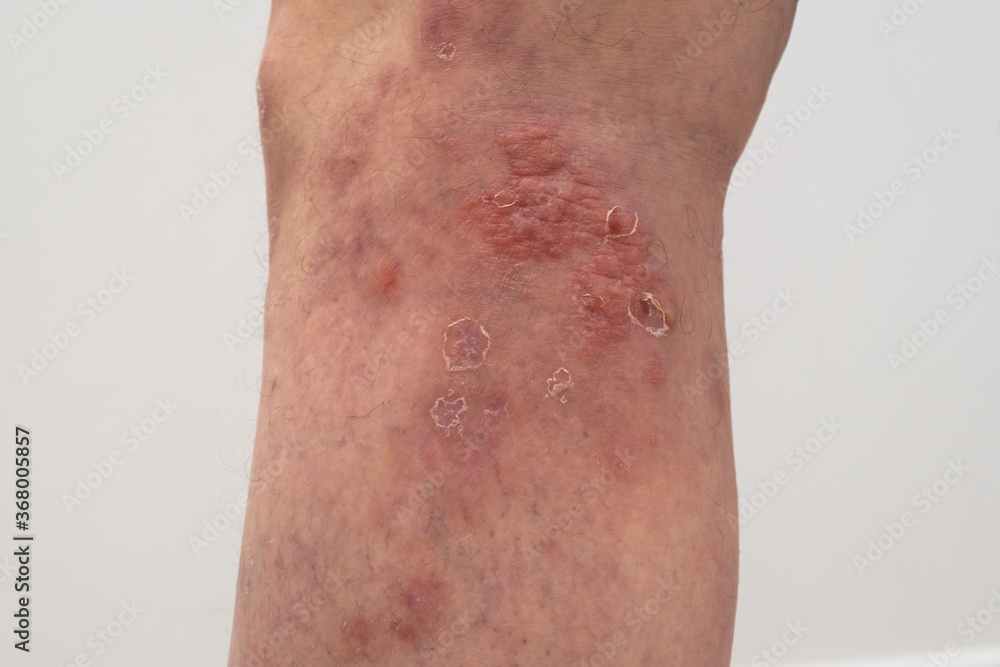 Naklejka premium close up photo of leg with psoriasis.