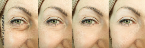 Fotografie woman face wrinkles before and after treatment, collage,