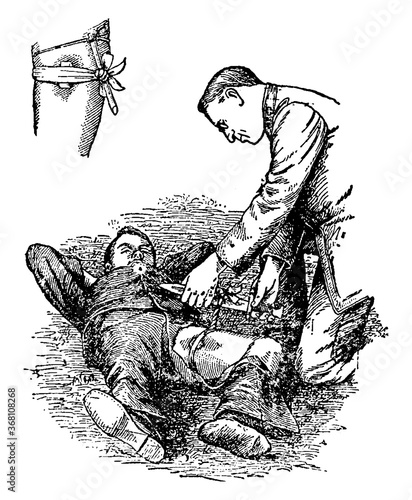 Tourniquet, vintage illustration