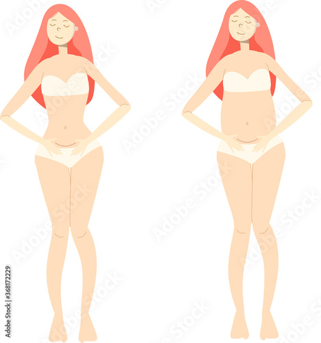 A set of two women, one of them with a scar after cesarean, and the second pregnant with a scar after cesarean. Vaginal birth after cesarean