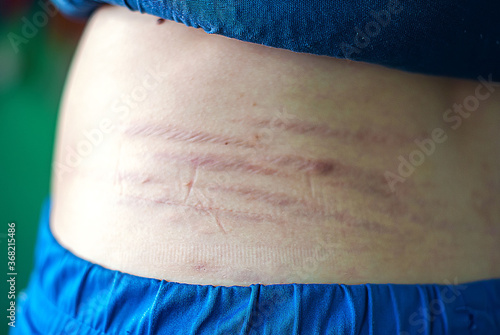 Foto Close-up of stretch marks on the back