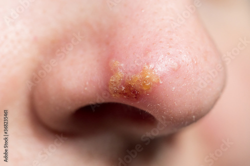 Closeup of Nose with herpes simplex infection and blisters photo