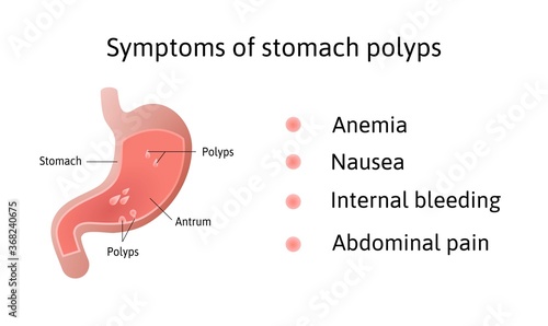 Symptoms of gastric polyps. pedunculated and flat-based polyp. Antrum. Anemia, nausea. Medical vector illustration marked with lines