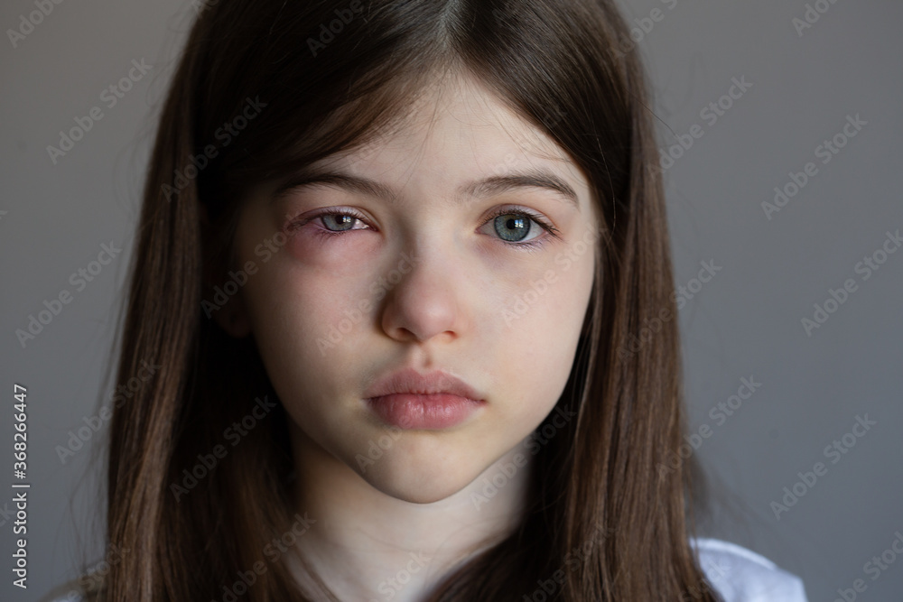 The young girl is allergic. Conjunctivitis, lacrimation, red eyes The young girl is allergic. Conjunctivitis, lacrimation, red eyes