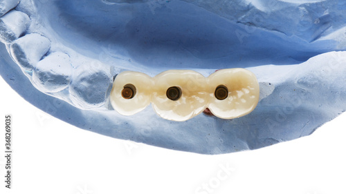 temporary crowns on abutments, top view on white background