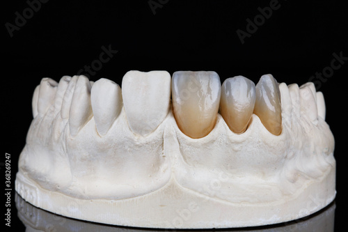 dental veneers of high quality and natural color on a special model, filmed on a black background photo