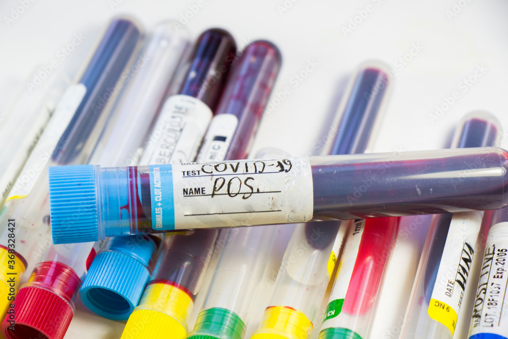 Corona virus, NCOV and Covid - 19 positive test samples. Blood tube samples. Diagnoses and laboratory research. Corona virus, NCOV and Covid - 19 positive test samples. Blood tube samples. Diagnoses and laboratory research.