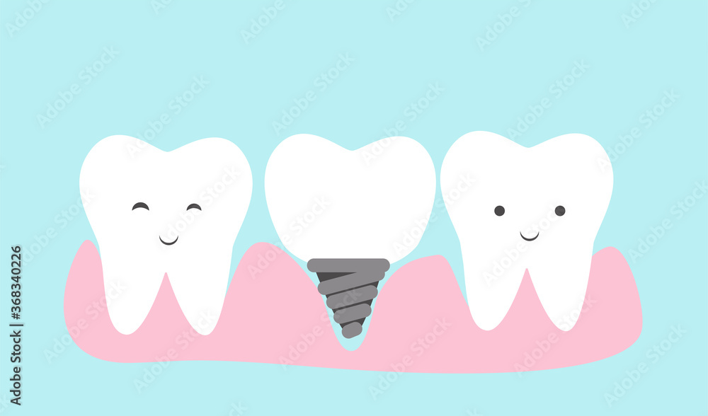 Cute teeth cartoon vector. Dental implant concept cartoon. Cute teeth cartoon vector. Dental implant concept cartoon.