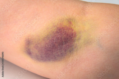 Canvas Print Closeup of a very large bruise on a human arm, after a botched blood draw