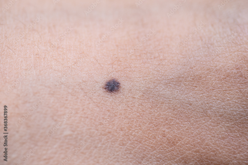 Moles are black spots that occur on the body. Stock Photo | Adobe Stock