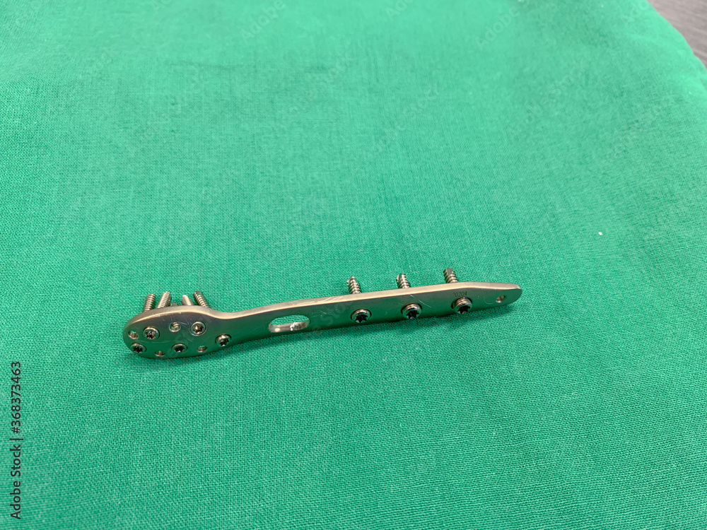 explanted titanium plate with screws from an ankle fracture lies on a