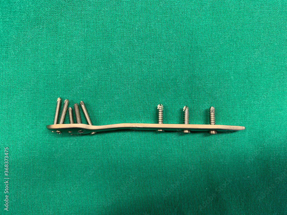 explanted titanium plate with screws from an ankle fracture lies on a ...