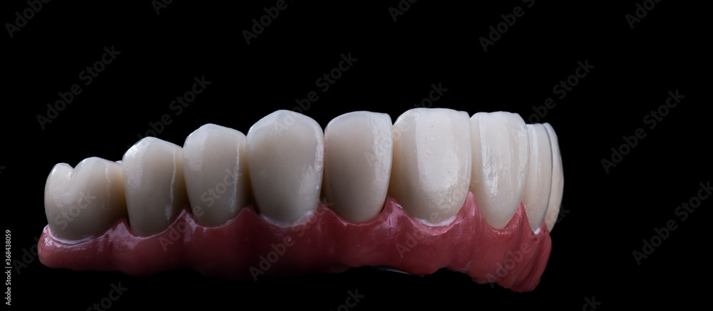 Obraz premium ceramic crowns done on 8 implants