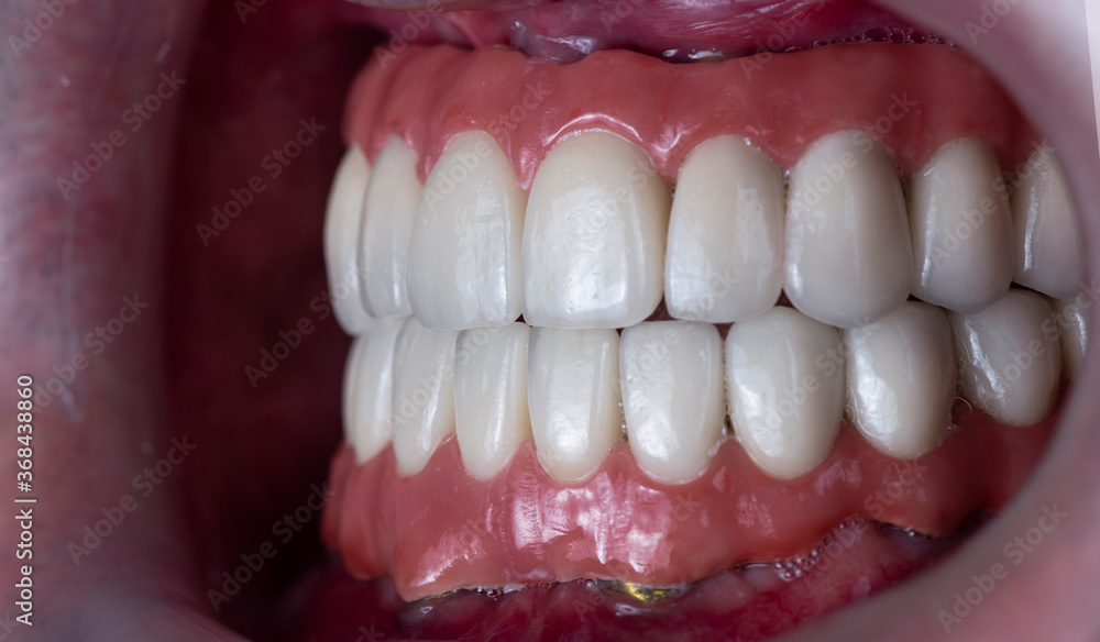 ceramic crowns done on 8 implants ceramic crowns done on 8 implants