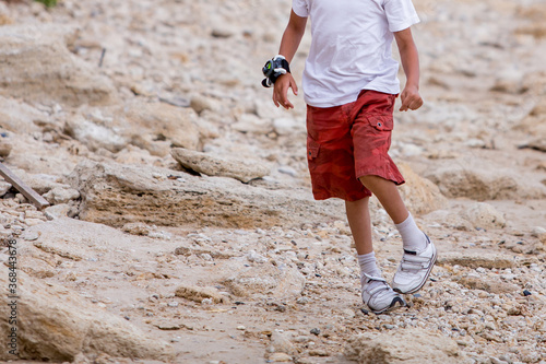 Boy walking with clubfoot defect photo