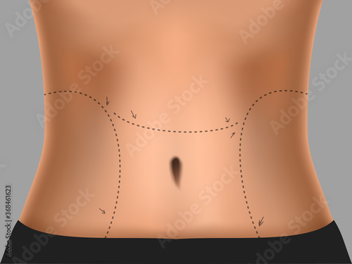 Tummy Marked Dotted Line For Plastic Surgery