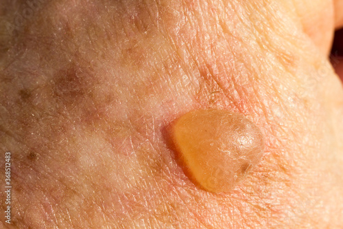 Fotografía Raised blister caused by cryotherapy to remove solar keratosis lesion