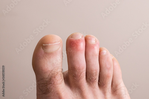 Detail of foot with chilblains on his fingers. Illness caused by cold. photo