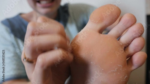 Foot fungus close-up, a woman has an itchy heel. The concept of dermatology, the treatment of fungal and fungal infections in humans