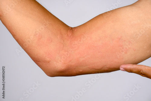 Closeup pictures of the skin are caused by severe hives urticaria.