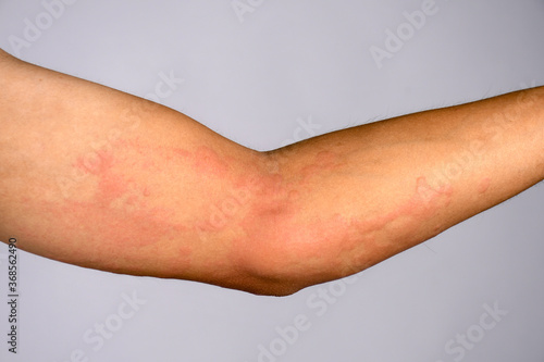 Closeup pictures of the skin are caused by severe hives urticaria. photo