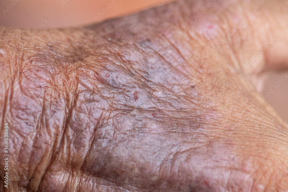 Fototapeta premium A physical of Atopic dermatitis (AD), also known as atopic eczema, is a type of inflammation of the skin (dermatitis).