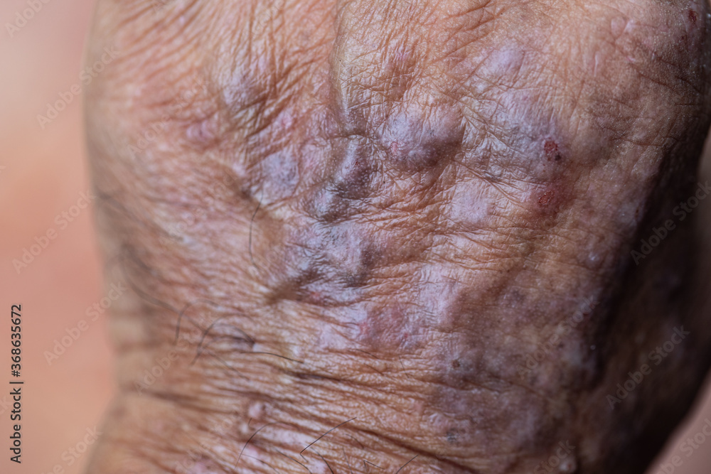 A physical of Atopic dermatitis (AD), also known as atopic eczema, is a type of inflammation of the skin (dermatitis).
A physical of Atopic dermatitis (AD), also known as atopic eczema, is a type of inflammation of the skin (dermatitis).