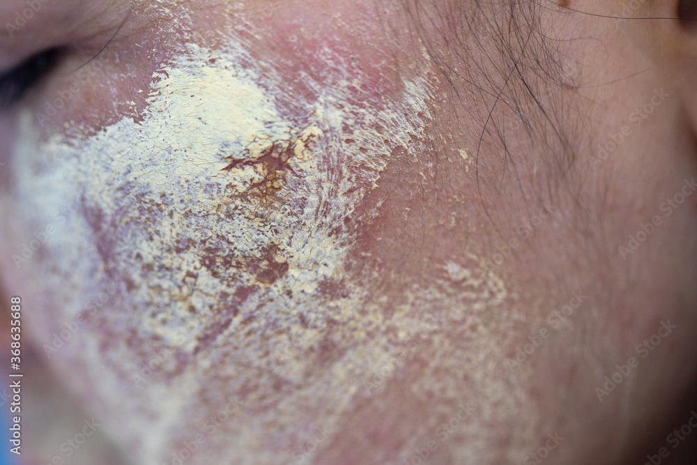 Fototapeta premium Backgrounds of lesions skin caused by acne on the face in the clinic. 