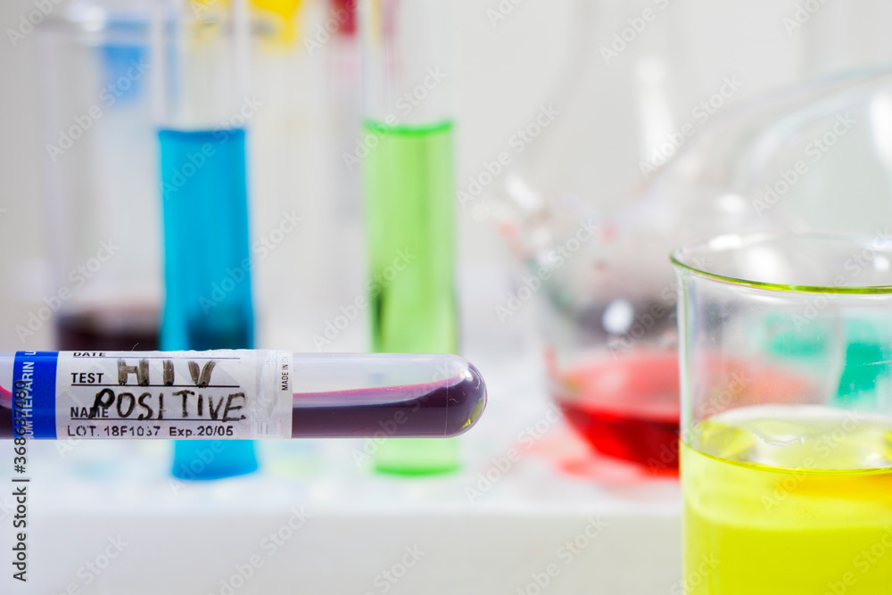 HIV blood test tube sample, aids and immune viruses. HIV blood test tube sample, aids and immune viruses.