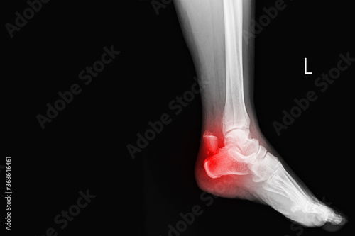 Film ankle X-ray radiograph showing heel bone broken (close fracture calcaneus) . Medical technology and healthcare concept.