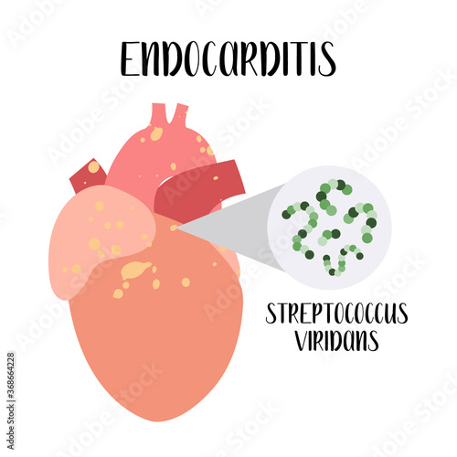 Endocarditis. Inflammation of the heart - endocardium. Streptococcus viridans. Vector flat cartoon illustration. Perfect for banner, medical brochure, flyer
