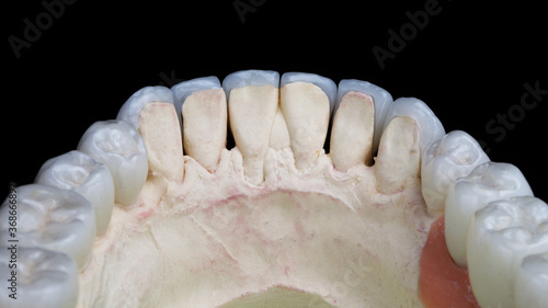 dental veneers and crowns on a gypsum model, internal view for fixing veneers