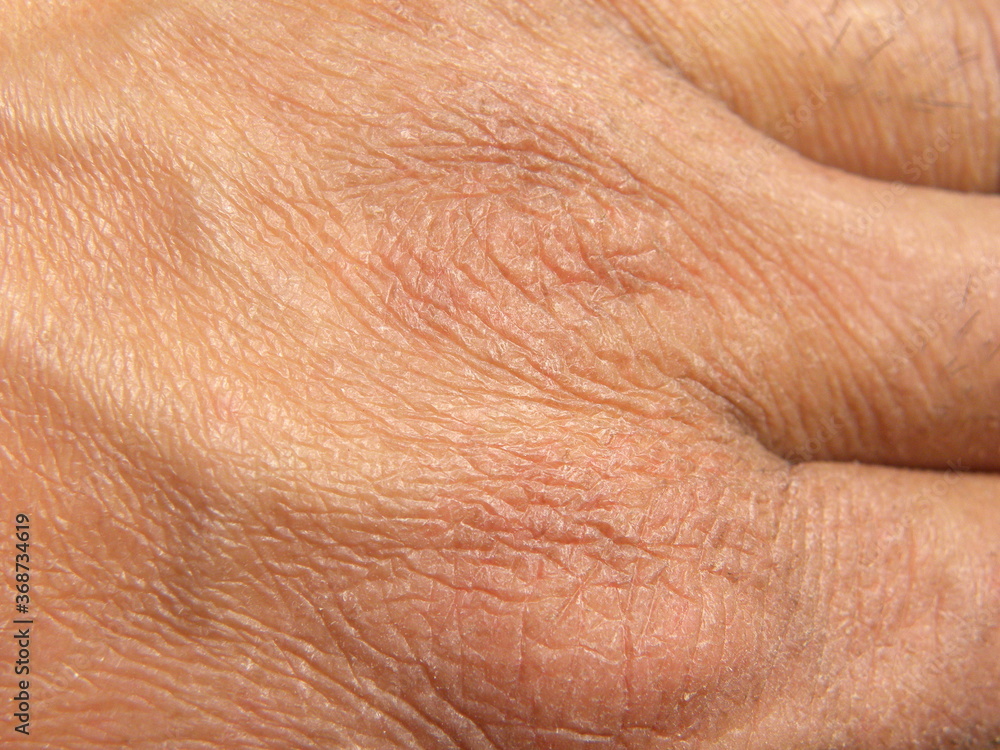Dry skin due to excessive use of hand sanitizer Dry skin due to excessive use of hand sanitizer