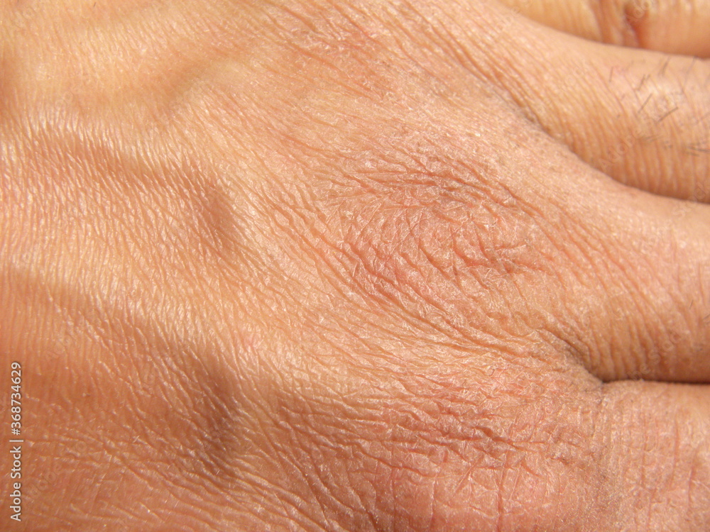 Dry skin due to excessive use of hand sanitizer Dry skin due to excessive use of hand sanitizer