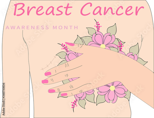 Тorso with a mastectomy for breast cancer with flowers. The woman covers her breasts with flowers. Breast cancer scar. Breast cancer awareness vector illustration. Poster design 