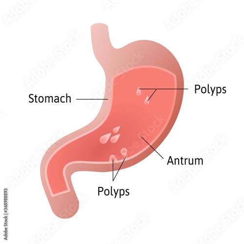 gastric polyps, masses of cells that form on the lining inside stomach. pedunculated and flat-based polyp. Antrum. Medical vector illustration marked with lines