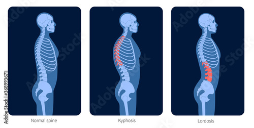 Spine X ray