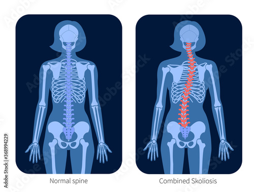 Spine X ray
