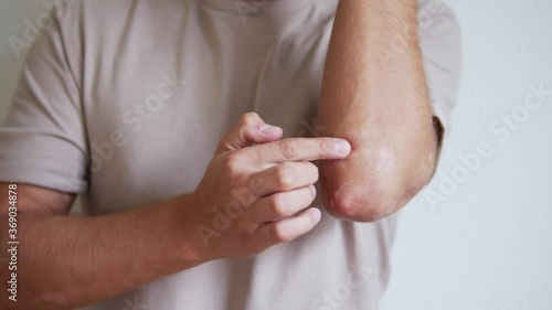 Close up of male applying ointment to heal the psoriasis skin condition 