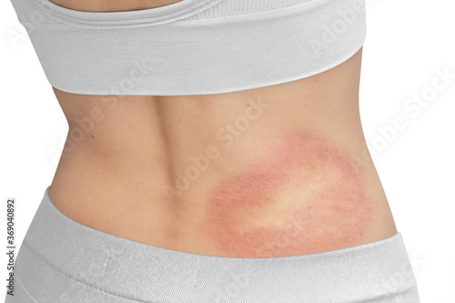 Red rash allergic skin on the waist of the back of a woman with clipping path