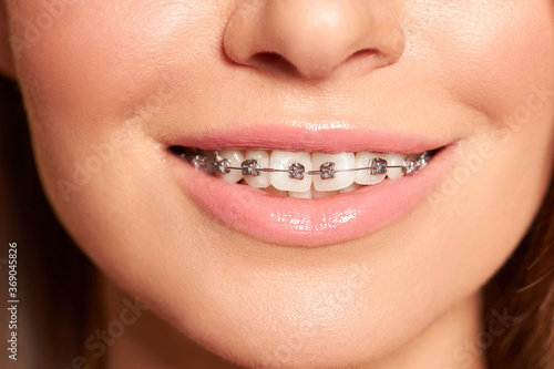 Closeup of woman teeth with braces