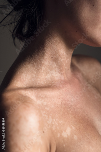 Skin with tinea versicolor photo