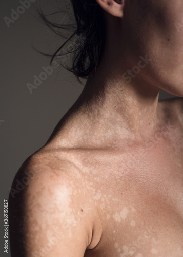 Wallpaper Mural Skin with tinea versicolor Torontodigital.ca