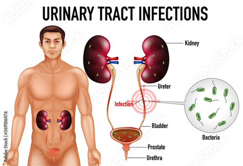Informative illustration of urinary tract infections