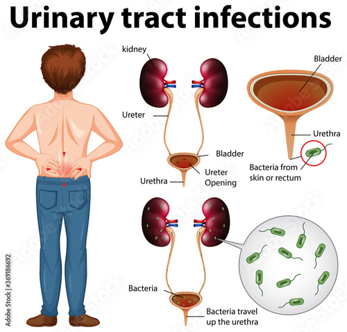 Informative illustration of urinary tract infections