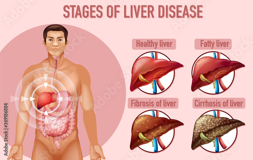 Stages of liver disease