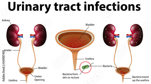 Informative illustration of urinary tract infections photo