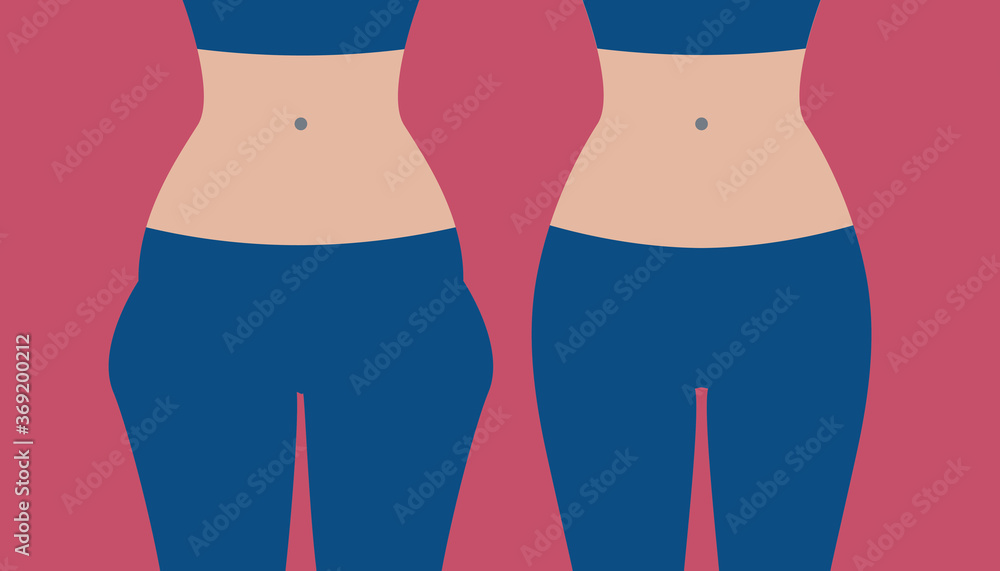 Hip liposuction, hip correction before and after Hip liposuction, hip correction before and after